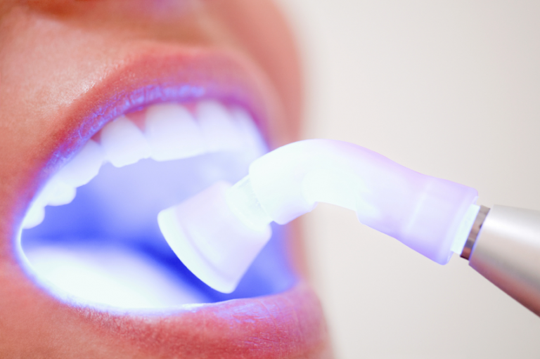 tratamiento con laser dental