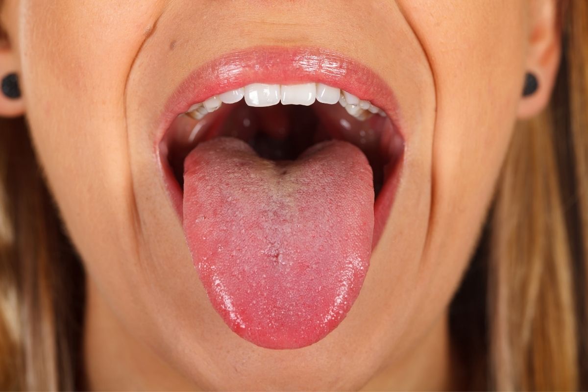 microondas Objetivo Indulgente Manchas rojas en la lengua - Clínica Dental Acacias