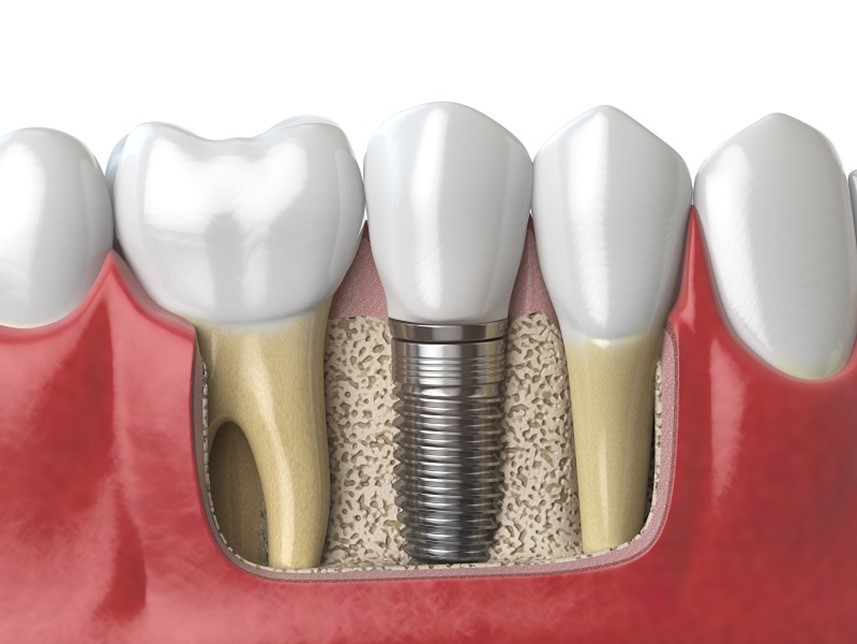 Especialistas en implantes dentales