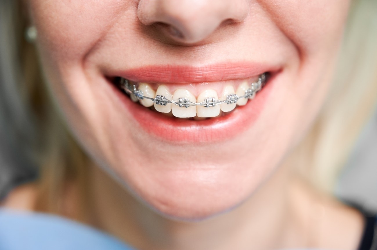 Tipos de ortodoncia: ¿Cuál es la mejor opción?